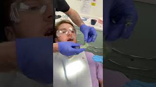 Loose teeth impression technique stage 5
