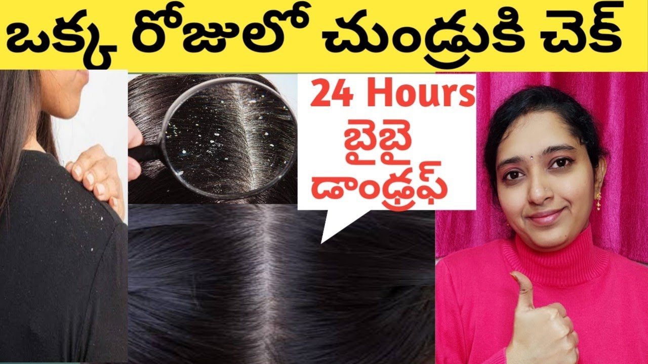 Dandruff Treatment At Home in Telugu/How to Remove Dandruff From Hair