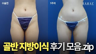 지방이식 상담 전에 보고 가세요! 골반 지방이식 전후 후기 모음