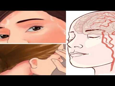 Dies passiert Tage vor einem Schlaganfall