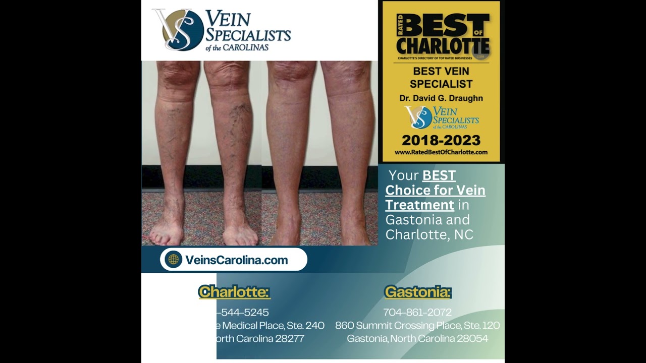 Vein Specialists of the Carolinas: Your BEST Choice for Vein Treatment in  Gastonia and Charlotte, NC 