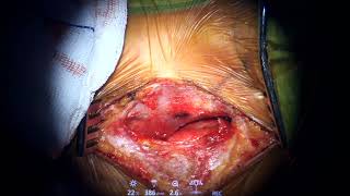 Teaching Cervical Disc Rerplacement (Unedited)