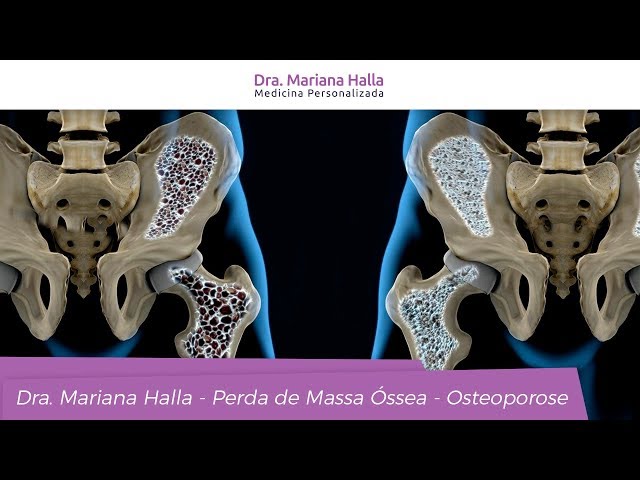 Perda de Massa Óssea: Osteoporose - Dra. Mariana Halla