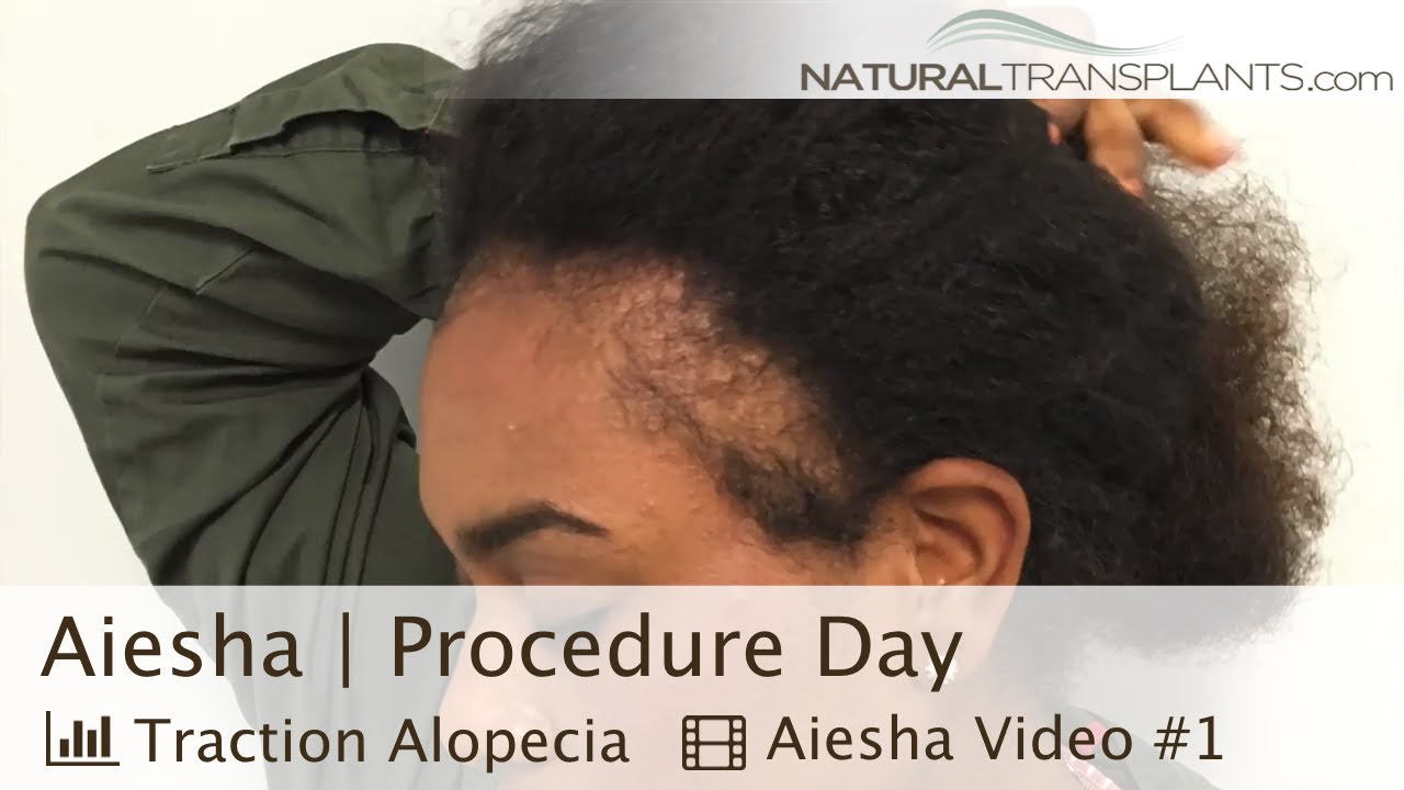 African American Thinning Edges Hair Transplant Surgery Dr Kevin