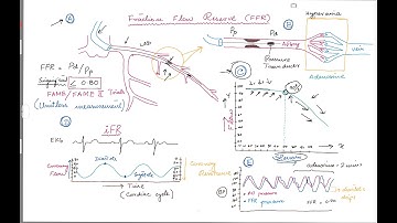 Coronary Angiogram . FFR (Fractional Flow Reserve)