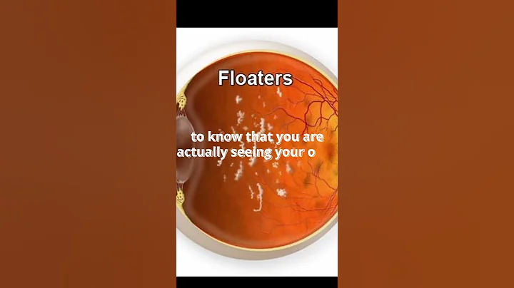 After rubbing your eyes, you must've experienced eye floaters... ||#shorts
