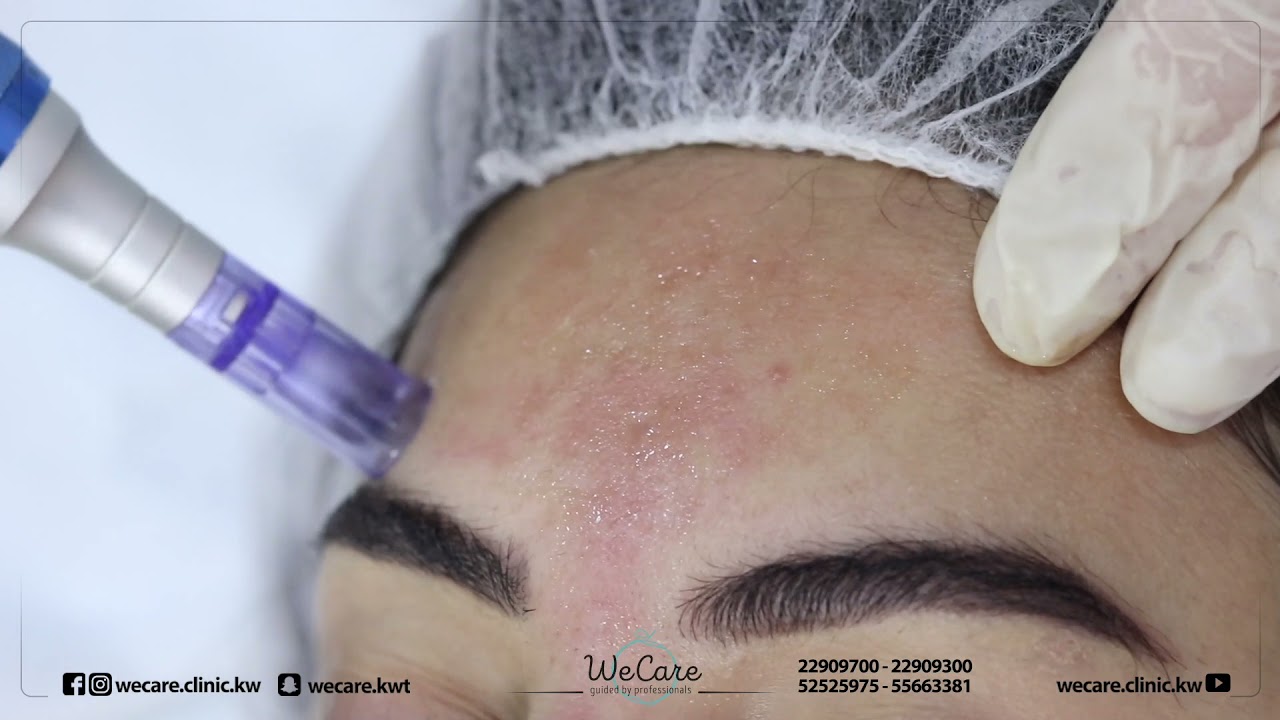 جلسة الديرمابن مع الميزوثيرابي لعلاج آثار حب الشباب