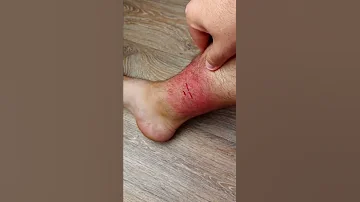 Как избавиться от укуса БОБРА. Последствия укуса.