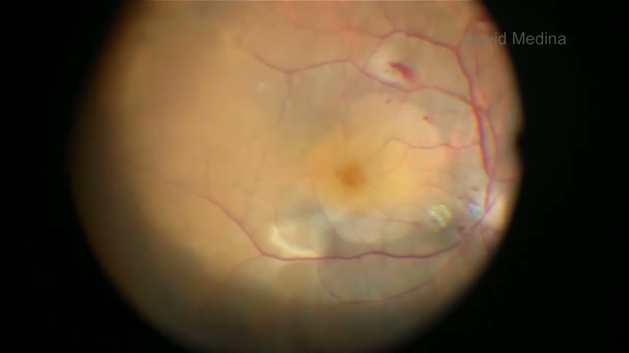 Proliferative Diabetic Retinopathy and tractional macular detachment.