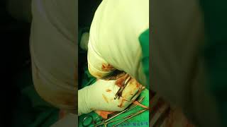 Traumatic Penile amputation (Homicidal), Penis cut off with knife.Emergency repair was done. part 1
