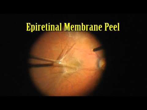 Pars Plana Vitrectomy with Epiretinal Peel for 20/400 Macular Pucker 