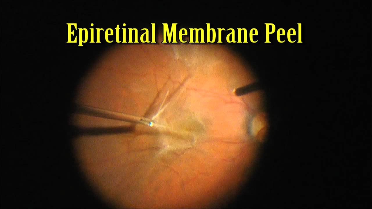 Pars Plana Vitrectomy With Epiretinal Peel For 20 400 Macular Pucker Pars Plana Vitrectomy With Epiretinal Peel For 20 400 Macular Pucker