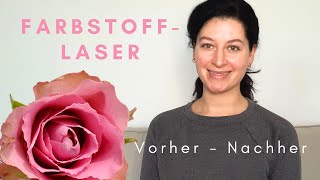 Der Gepulste Farbstofflaser bei Couperose und Rosazea // Meine Erfahrung mit Vorher-Nachher-Bildern