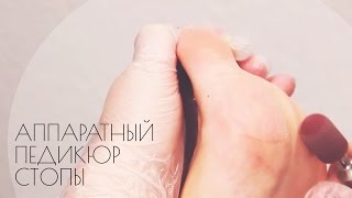 Аппаратный педикюр стопы(Аппаратный педикюр стопы Для обработки стопы при аппаратном педикюре используются твердосплавные насадки..., 2014-03-28T05:20:19.000Z)