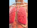 Tuberculosis (TB) &amp;  Mycobacterium tuberculosis (Mtb) #science #dnasequencing #cancer