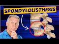 Spondylolisthesis: 4 Exercises to Reduce Pain (Demo on Real Patient)