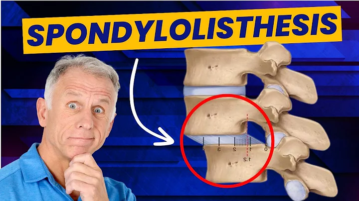 Spondylolisthesis: 4 Exercises to Reduce Pain (Demo on Real Patient) - DayDayNews