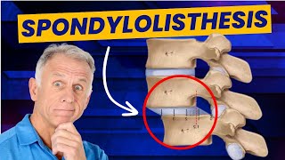 Spondylolisthesis: 4 Exercises to Reduce Pain (Demo on Real Patient) screenshot 4