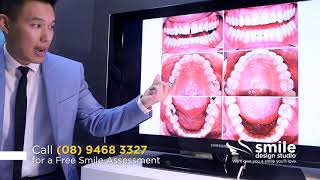 Damon Clear Braces - Treatment for Gaps, Crowding and Narrow Arches