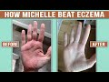 Beyond relief michelles eczema healing transformation  the eczema podcast s6e35