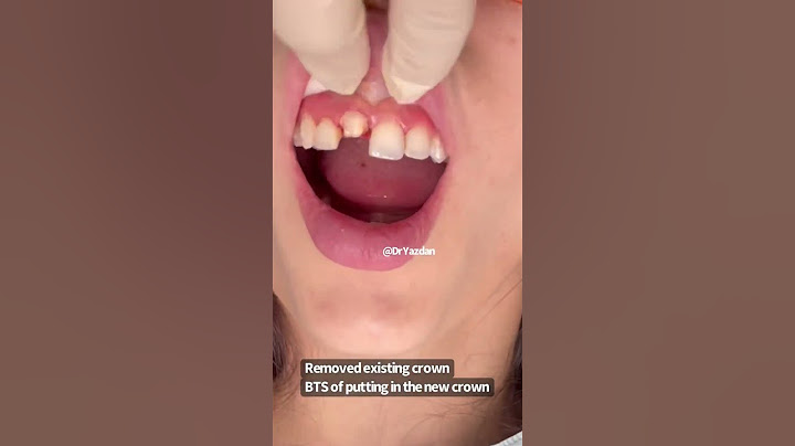 Front tooth crown | porcelain crown procedure | dental crown | Dr. Yazdan #cosmeticdentistry