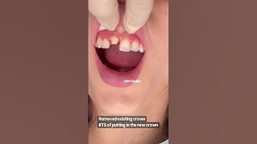 Front tooth crown | porcelain crown procedure | dental crown | Dr. Yazdan #cosmeticdentistry