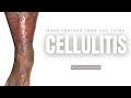 Cellulitis more serious than you think