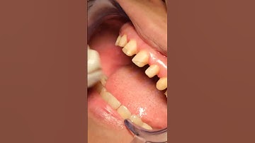 Khi nào nên bọc Răng Sứ?