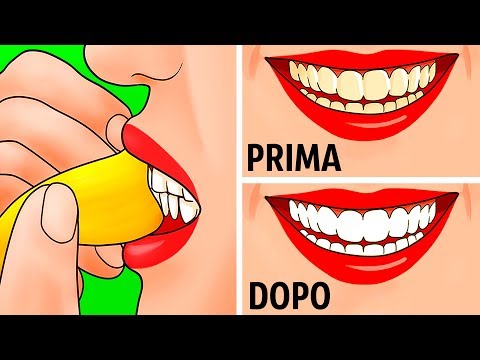 Video: Come trattare le infezioni nei denti del giudizio (con immagini)