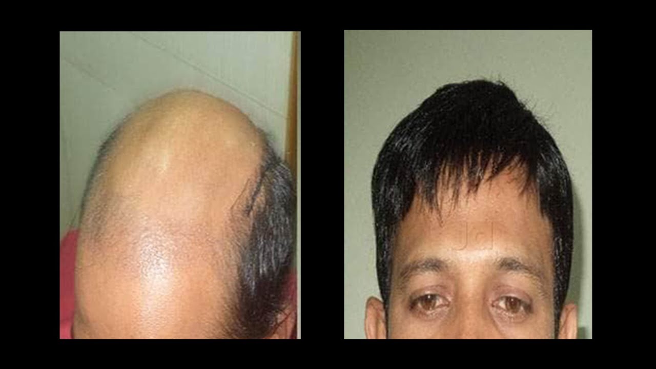 Ultimo Capelli Hair Replacement Center in Pune