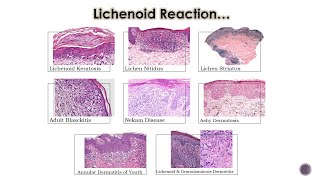 8- Lichenoid Dermatoses (2)