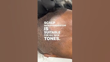 Scalp Micropigmentation For Male Pattern Baldness | The Scalp Clinic