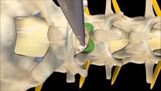 Orthopedic Pain Specialists and Dr Tim Davis Present Totalis Lumbar Decompression System