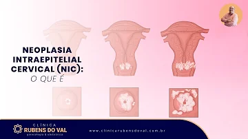 O que é neoplasia intraepitelial cervical grau 3?