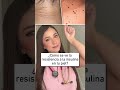 Así se ve la “Resistencia a la Insulina” en tu piel #medicina #resistenciaalainsulina  #alopecia