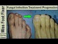 Nail treatment progression photo before and after by fungal nail expert