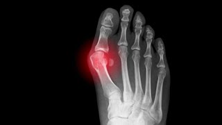 Santé - Hallux valgus : la solution chirurgicale