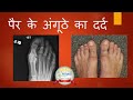 Great Toe Pain  Hindi (Hallux Rigidus)पैर  के अंगूठे का दर्द