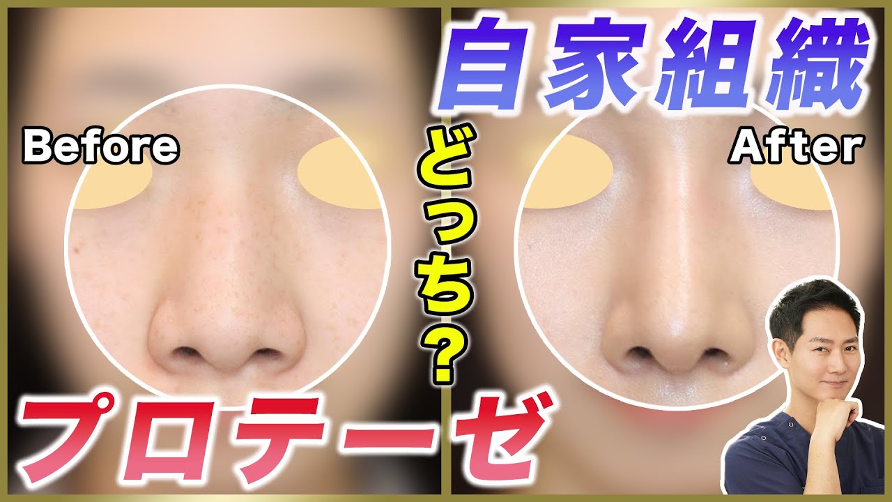 Rhinoplasty] Should I use a prosthesis or autologous tissue to