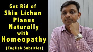 How to Get Rid of Skin Lichen Planus Naturally with Homeopathy & Home Remedies & Diet Tips