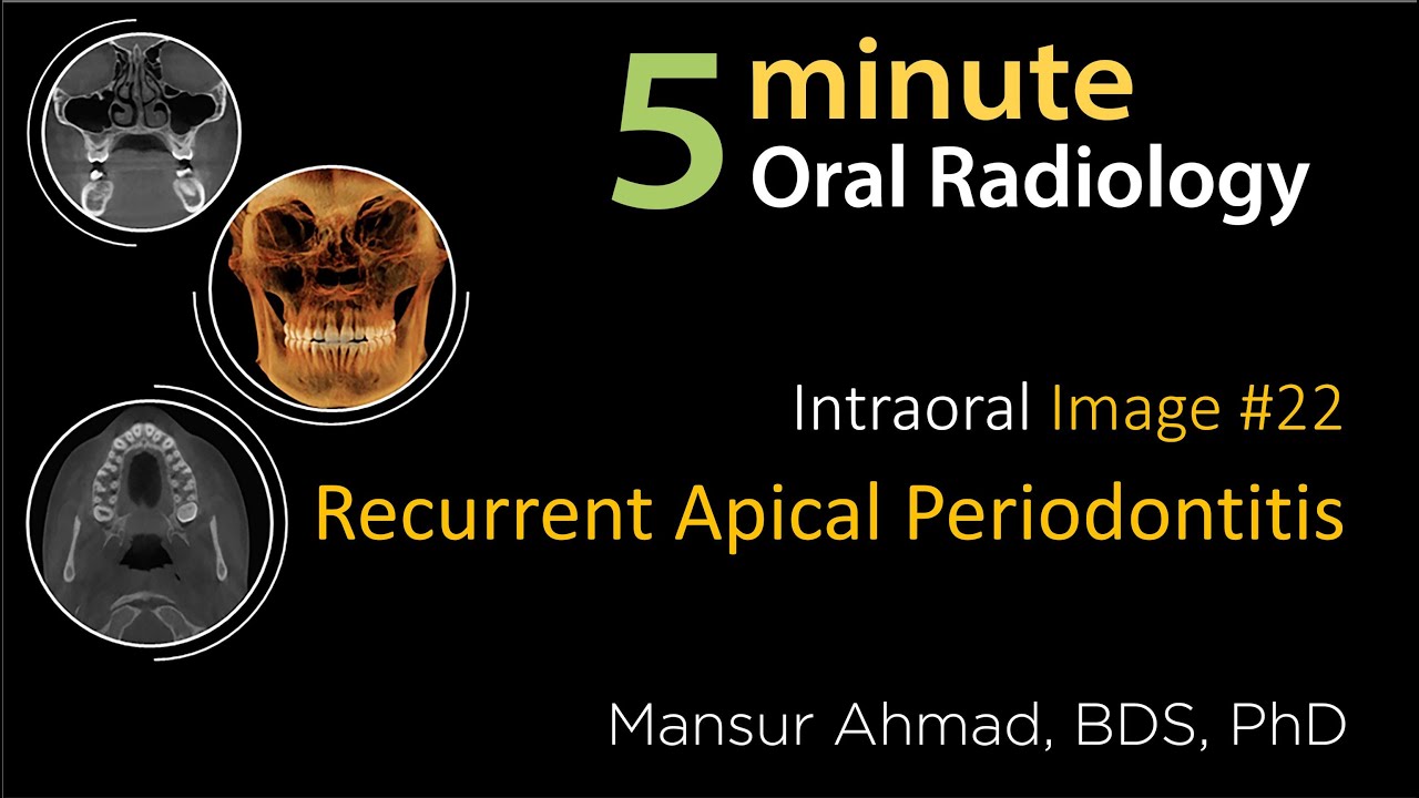 Recurrent apical periodontitis: Intraoral Radiographic Interpretation