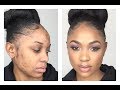 How to Cover Acne Scars / Color Correcting