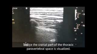 US-Guided Thoracic Paravertebral Block (TPVB)