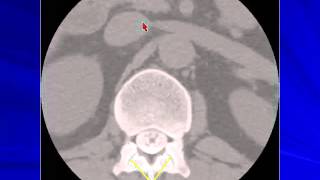 20 CT Anatomy of spine