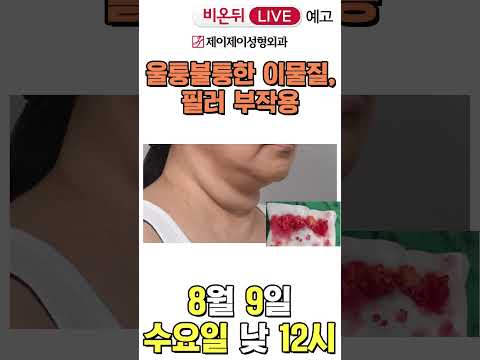 [비온뒤 예고] 울퉁불퉁한 <strong>이물질</strong>, 필러 부작용- 유튜브 의학채널 비온뒤 (제이제이성형외과)#shorts