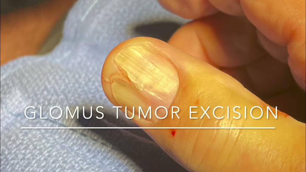 Glomus Tumor Removal St. Louis Nail Surgery Painful Fingernail Cyst