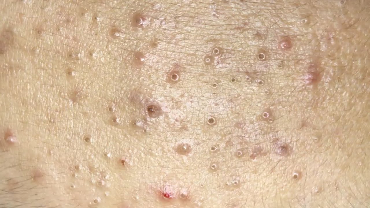 AWESOME POPPING BLACKHEADS FIELD | Suri Job 130