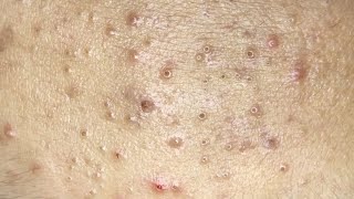 AWESOME POPPING BLACKHEADS FIELD Suri Job 130