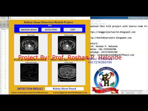 Kidney Stone Detection Using Image Processing | With Source Code | Kidney Stone Classification