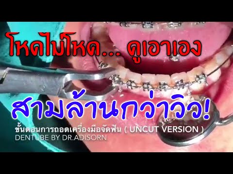 Ep.11 การถอดเครื่องมือจัดฟัน (debond braces)